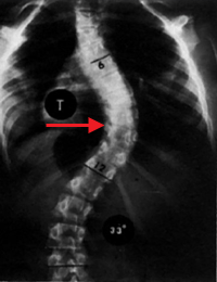 Scoliosis (2).gif